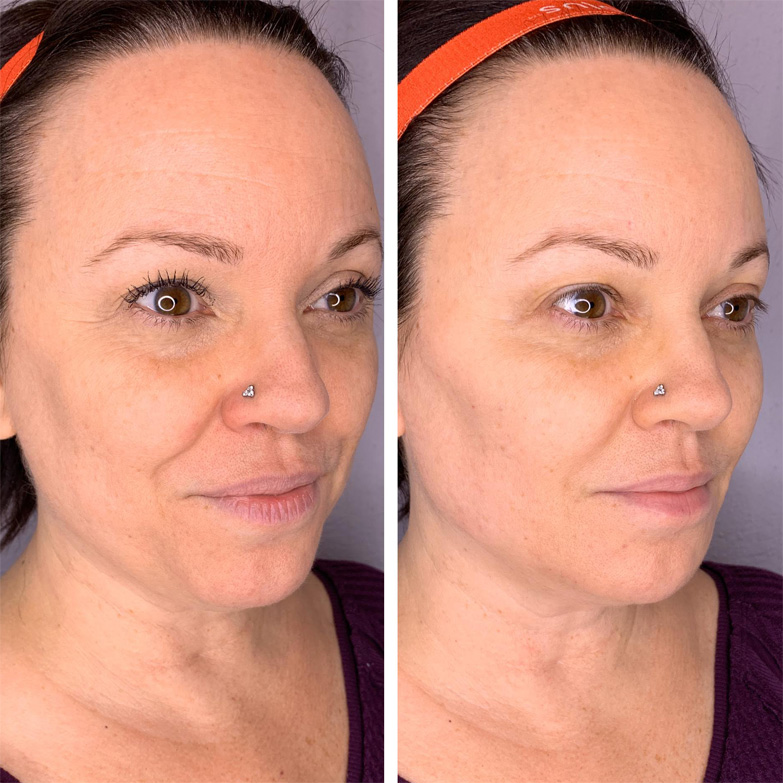 Radiesse filler Before & After in Massachusetts