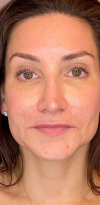 DAXXIFY® treatment before and after 1-month result at Dr. Happe Medical Aesthetics in Newton, Boston.