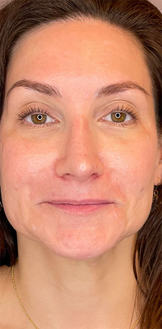 DAXXIFY® treatment before and after 1-month result at Dr. Happe Medical Aesthetics in Newton, Boston.