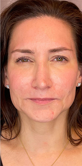 DAXXIFY® treatment before and after 1-month result at Dr. Happe Medical Aesthetics in Newton, Boston.