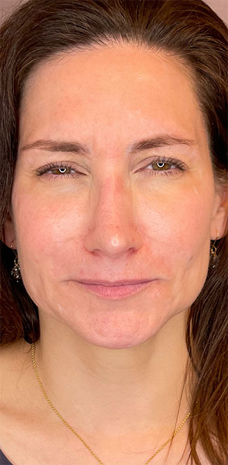 Daxxify treatment before and after 1-month result at Dr. Happe Medical Aesthetics in Newton, Boston.