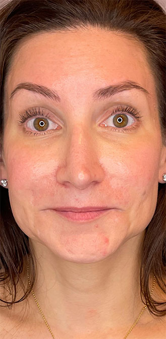 DAXXIFY® treatment before and after 1-month result at Dr. Happe Medical Aesthetics in Newton, Boston.