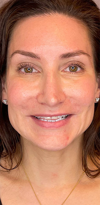 DAXXIFY® treatment before and after 1-month result at Dr. Happe Medical Aesthetics in Newton, Boston.