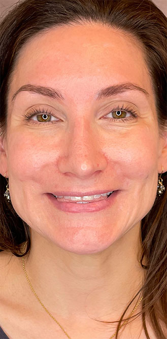 DAXXIFY® treatment before and after 1-month result at Dr. Happe Medical Aesthetics in Newton, Boston.