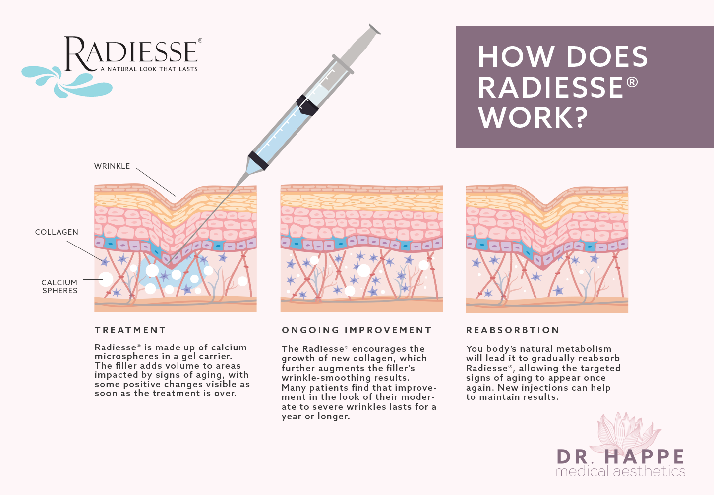 Learn how Radiesse® works at the Boston area’s Dr. Happe Medical Aesthetics.