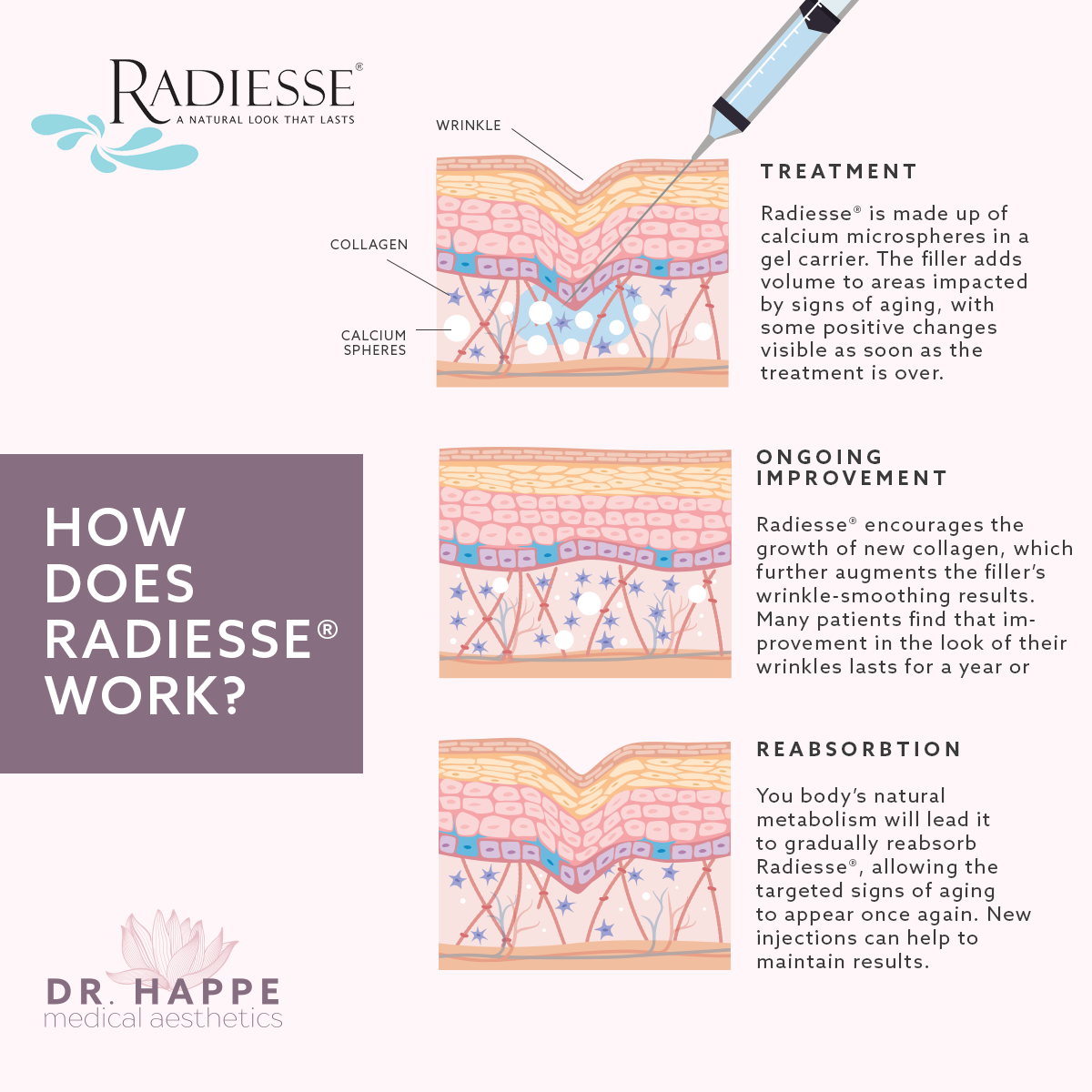 Learn how Radiesse® works at the Boston area’s Dr. Happe Medical Aesthetics.