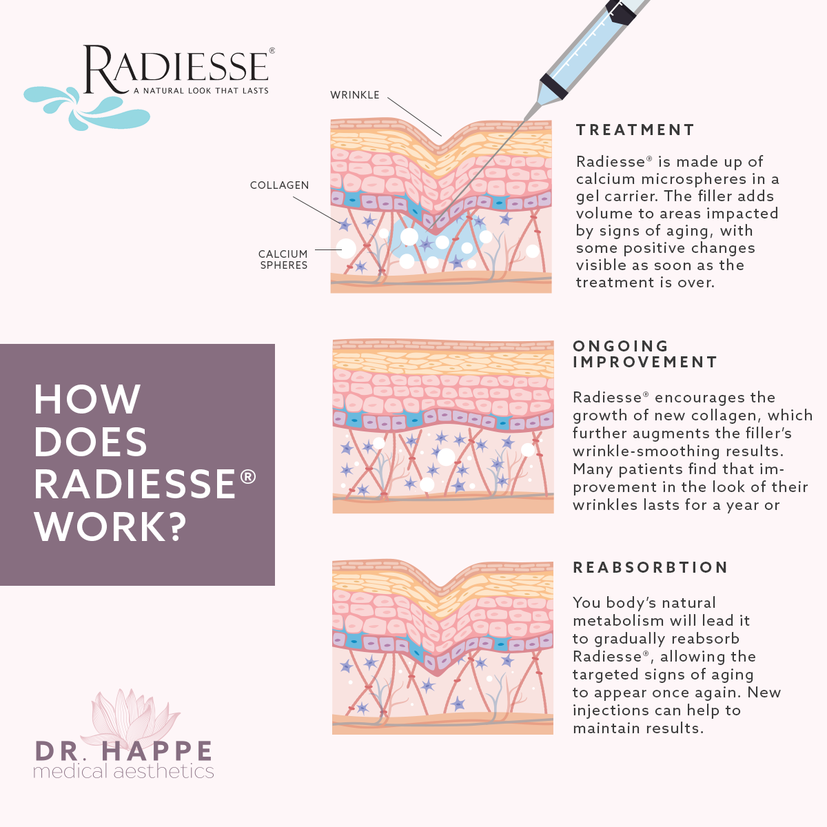 Learn how Radiesse® works at the Boston area’s Dr. Happe Medical Aesthetics. Learn how Radiesse® works at the Boston area’s Dr. Happe Medical Aesthetics.