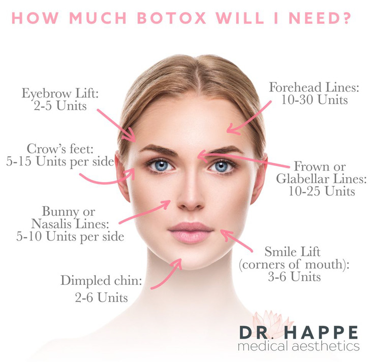 How much BOTOX will I need?
