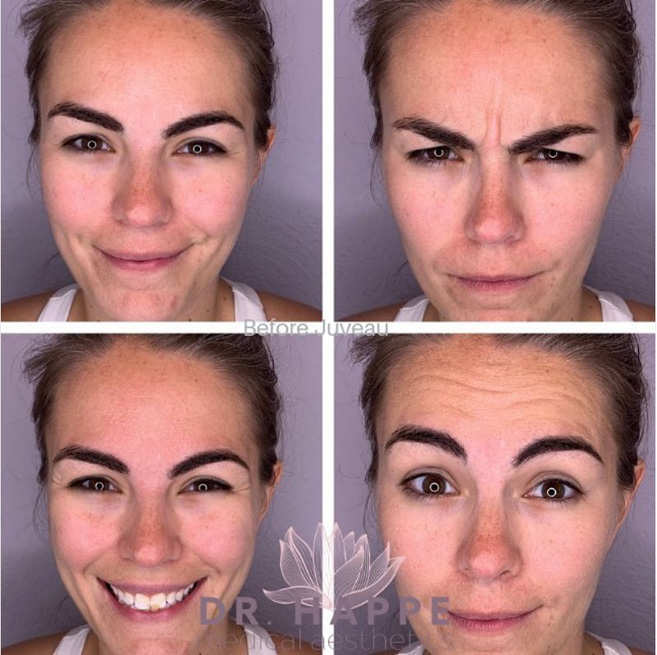Before and after – Jeuveau in Newton, MA Before and after – Jeuveau in Newton, MA