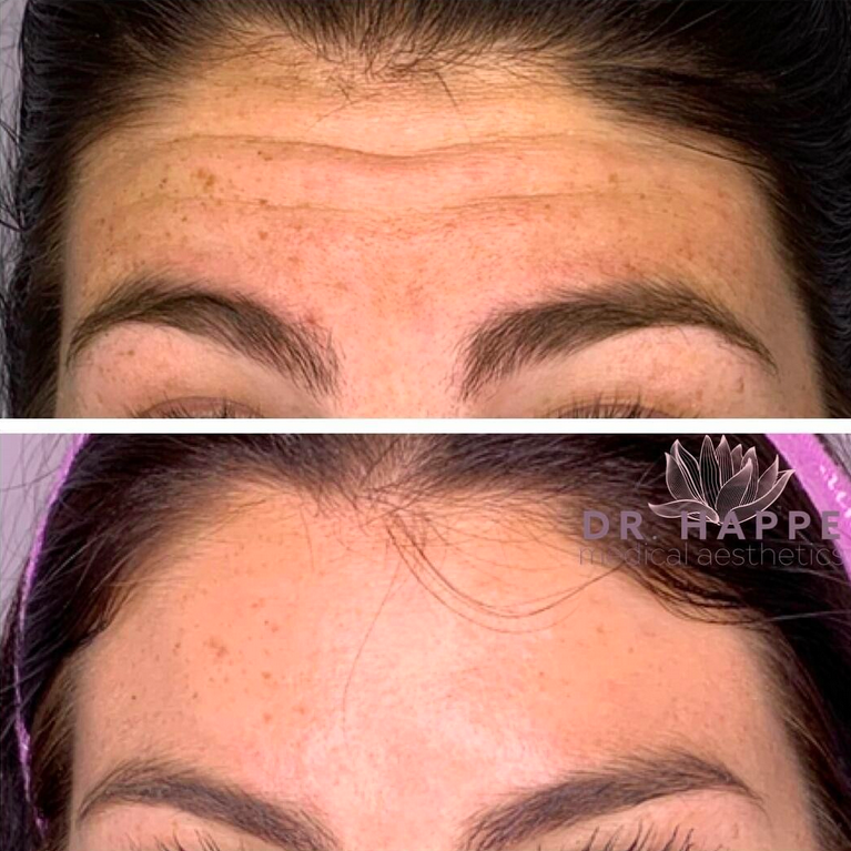 Botox for forehead before & after.