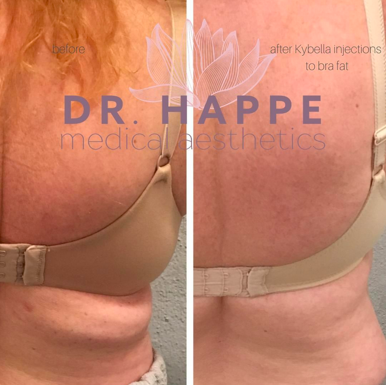Kybella can be used as a bra roll fat reduction treatment. Kybella can be used as a bra roll fat reduction treatment.