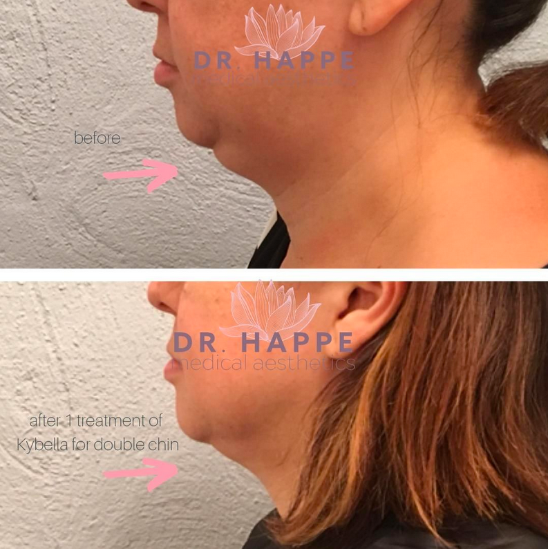 Kybella for double-chin treatment, before & after.
