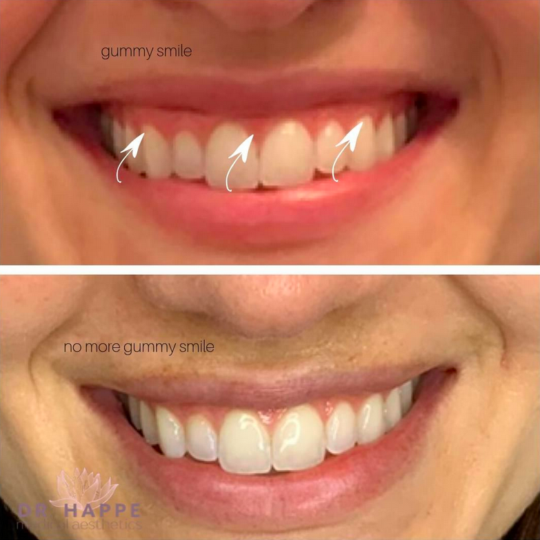 gummy smile before & after.