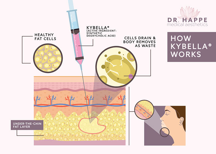 The active ingredient in BELLA® at Newton's Dr. Happe Medical Aesthetics is a form of naturally occurring deoxyvholic acid, which breaks down fat cells. The active ingredient in BELLA® at Newton's Dr. Happe Medical Aesthetics is a form of naturally occurring deoxyvholic acid, which breaks down fat cells.