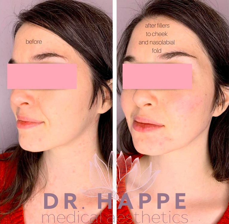 Radiesse for cheeks and nasolabial folds in Boston. Radiesse for cheeks and nasolabial folds in Boston.