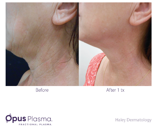 Opus Plasma Before After Opus Plasma Before After