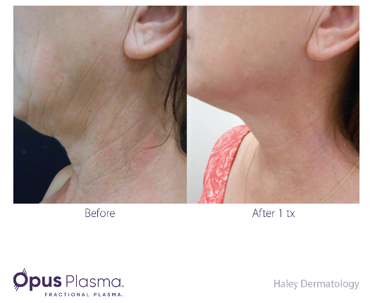 Opus Plasma Before After