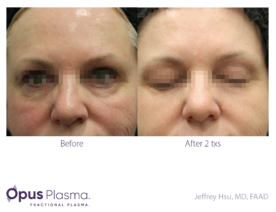 Opus Plasma Before After Opus Plasma Before After