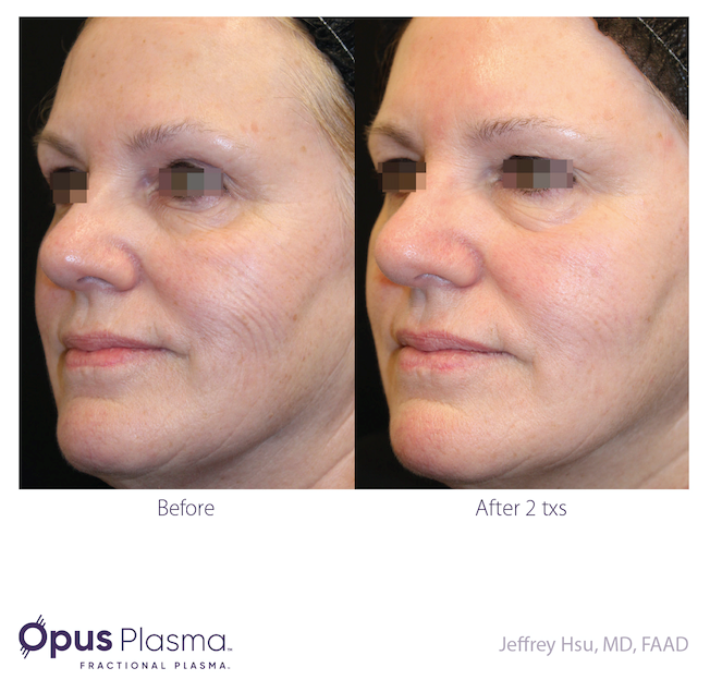 Opus Plasma Before After