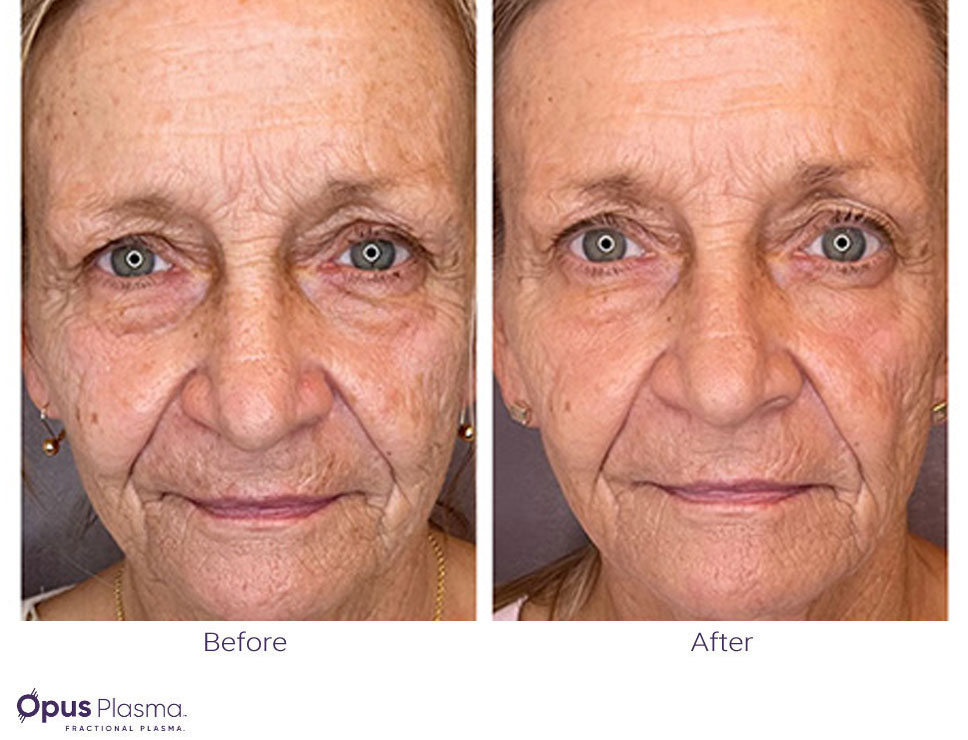 Opus Plasma Before After Opus Plasma Before After