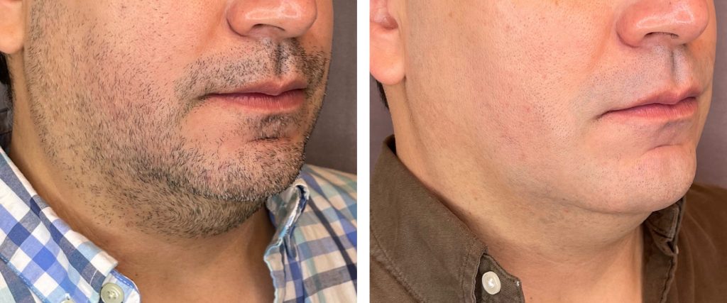 Kybella for chin