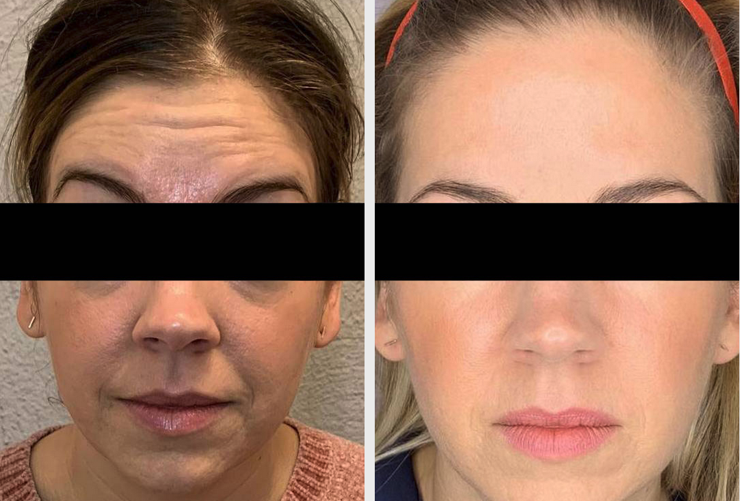 Botox before and after