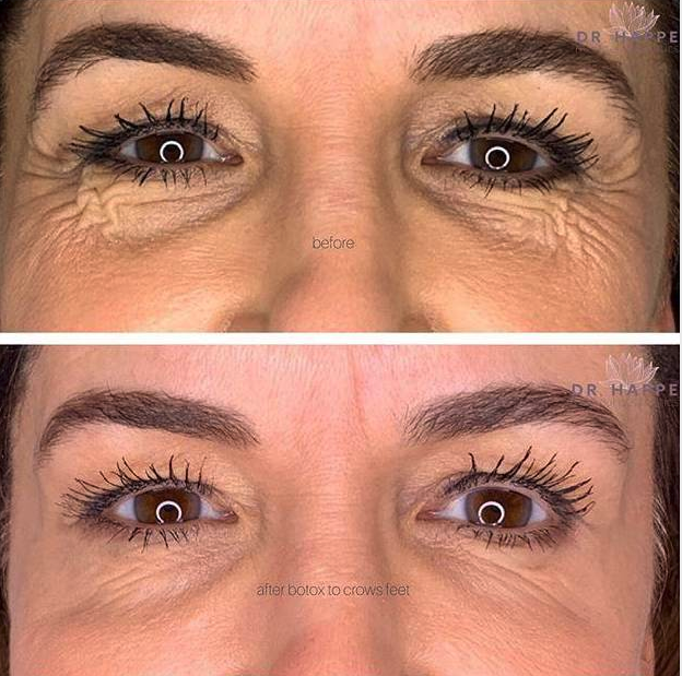 Botox before and after