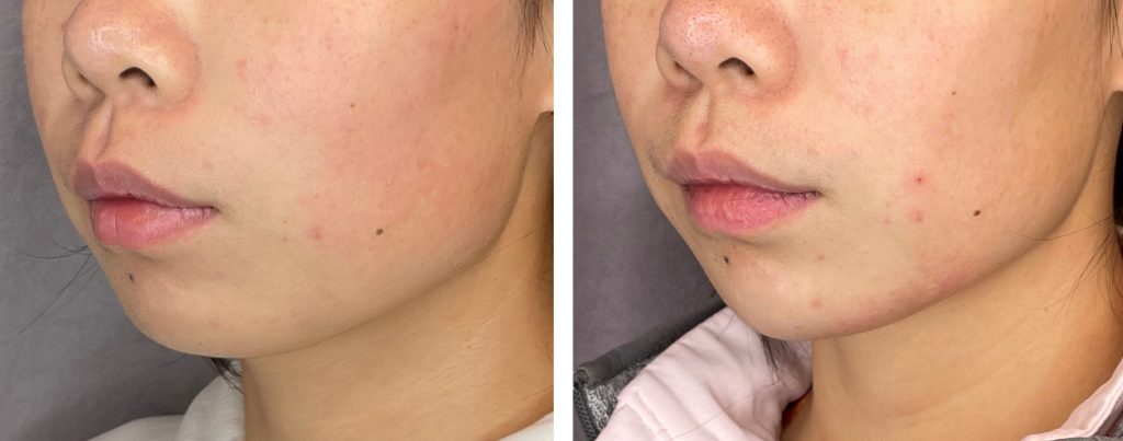 Juvederm Voluma for jawline