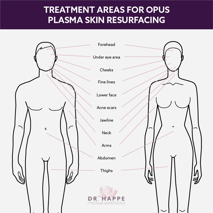Opus Plasma® at the Boston area's Dr. Happe Medical Aesthetics can tighten and repair skin all over the face and body. Opus Plasma® at the Boston area's Dr. Happe Medical Aesthetics can tighten and repair skin all over the face and body.