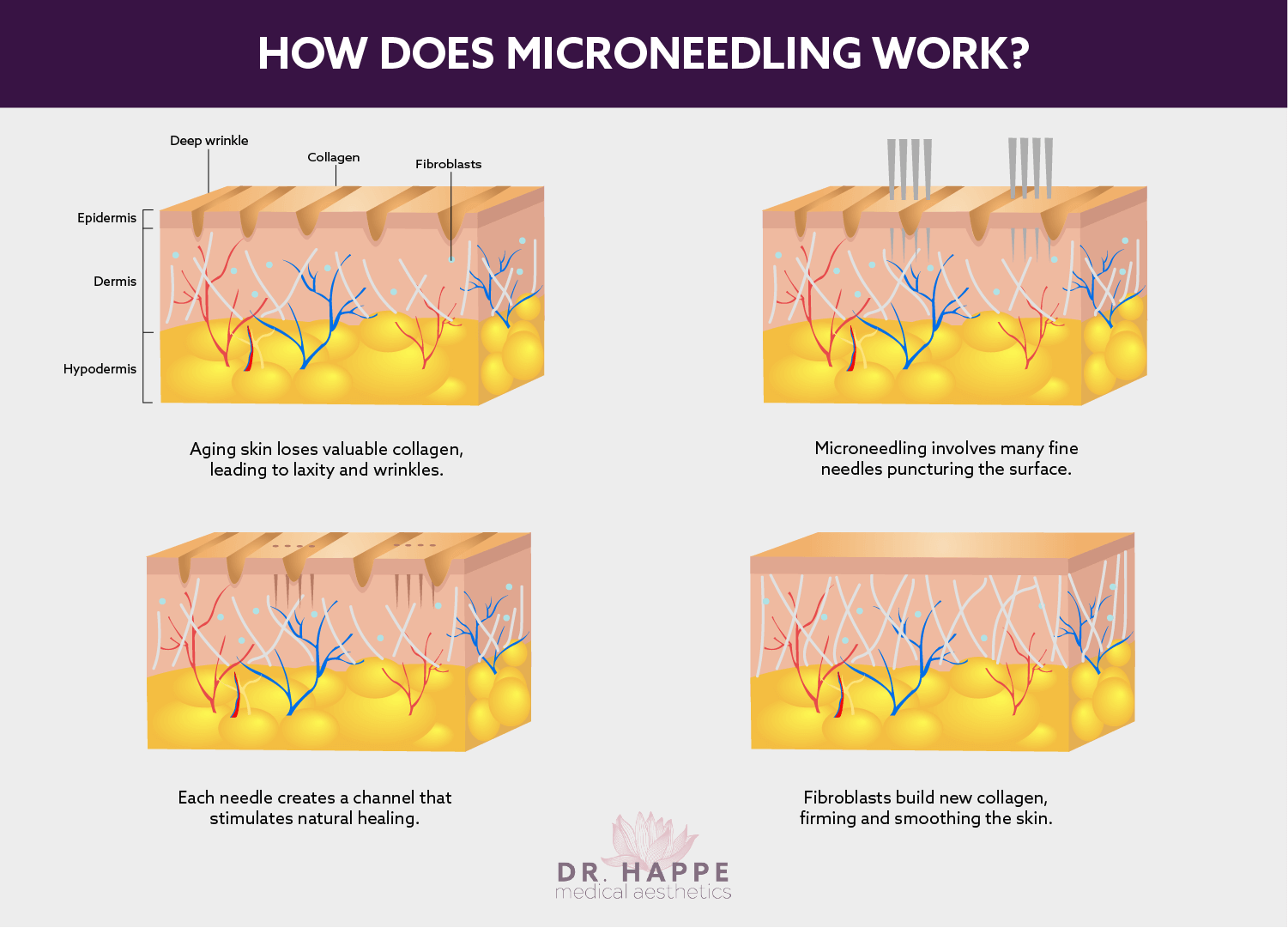 Learn about microneedling at the Boston area’s Dr. Happe Medical Aesthetics. Learn about microneedling at the Boston area’s Dr. Happe Medical Aesthetics.
