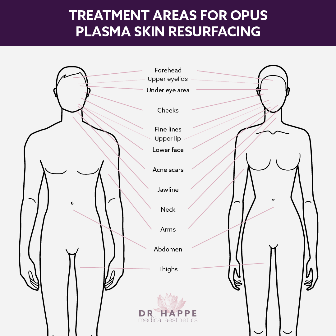 Opus Plasma® at the Boston area's Dr. Happe Medical Aesthetics can tighten and repair skin all over the face and body. Opus Plasma® at the Boston area's Dr. Happe Medical Aesthetics can tighten and repair skin all over the face and body.